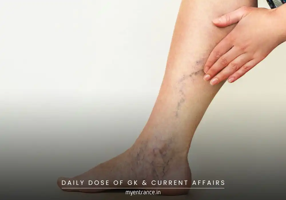 Chronic Venous Insufficiency (CVI) – Symptoms, Causes, and Treatment