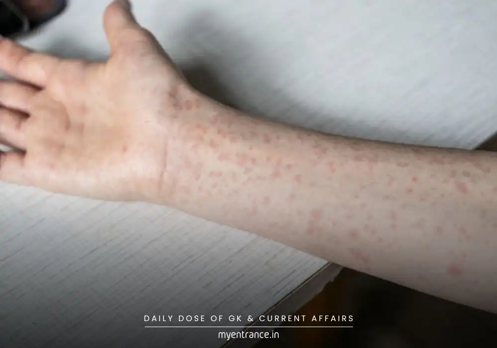 Measles Outbreaks on the Rise: Is Declining Vaccination to Blame